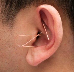 Acupuncture and auriculotherapy to stop smoking